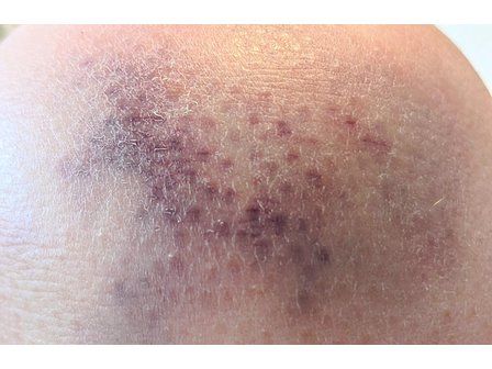 Hematomas y Sol