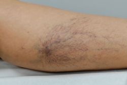 Los 3 Beneficios del uso de medias elásticas compresivas tras la escleroterapia para el tratamiento de varices