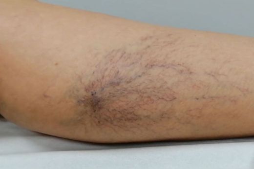 Los 3 Beneficios del uso de medias elásticas compresivas tras la escleroterapia para el tratamiento de varices