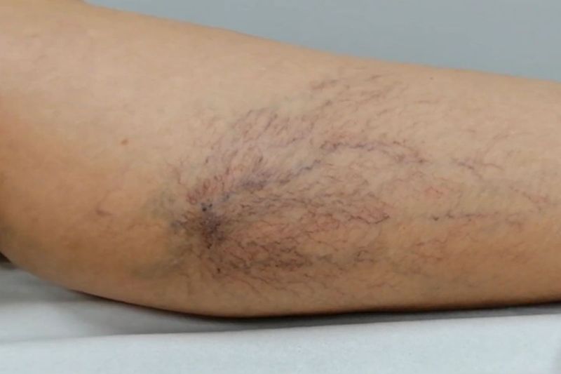 Los 3 Beneficios del uso de medias elásticas compresivas tras la escleroterapia para el tratamiento de varices