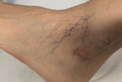 ¿Sabes qué son las arañas vasculares o telangiectasias?