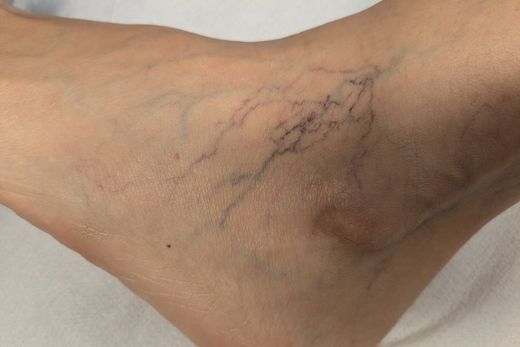 ¿Sabes qué son las arañas vasculares o telangiectasias?