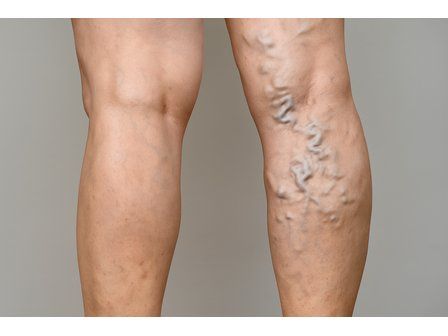 ¿Qué son las varices? Síntomas y tratamientos