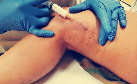 ¿Qué es la escleroterapia y para qué sirve?